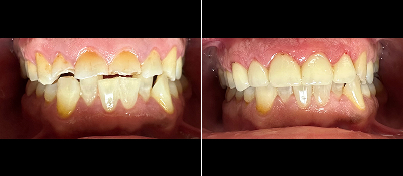 Crooked teeth correction before and after by dentist in Paramount.