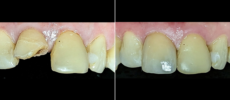 Before and after dental treatment for chipped tooth by dentist near you in Paramount.