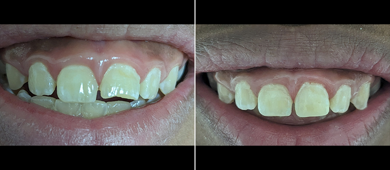 Before and after misaligned teeth correction, orthodontics in Paramount.