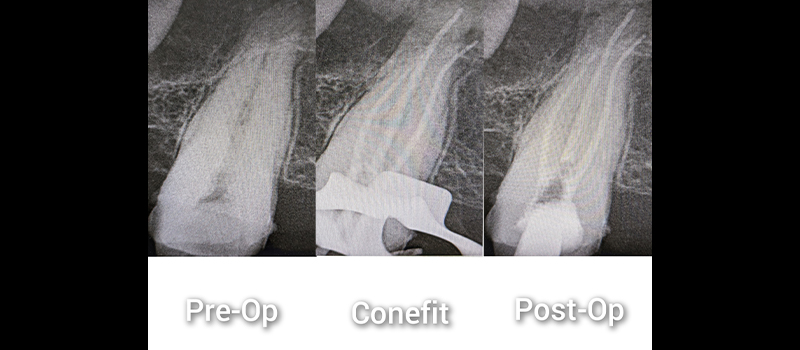 Root canal therapy X-ray showing pre-op, conefit, and post-op stages.