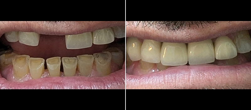 Before and after image of teeth cleaning at Paramount dental office.