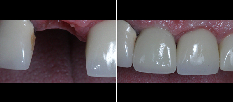 Before and after of tooth replacement at dentist near you in Paramount.
