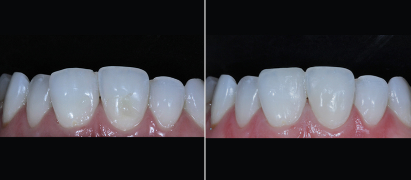 Chipped Front Teeth Before & After Photos
