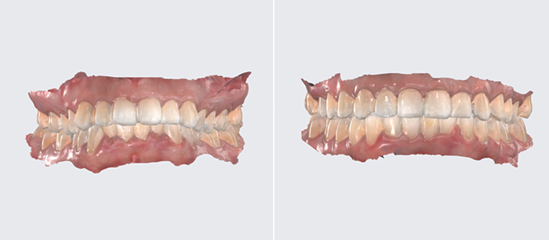 Porcelain Crowns