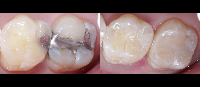 Tooth filling treatment results, dental care by Paramount dentist.