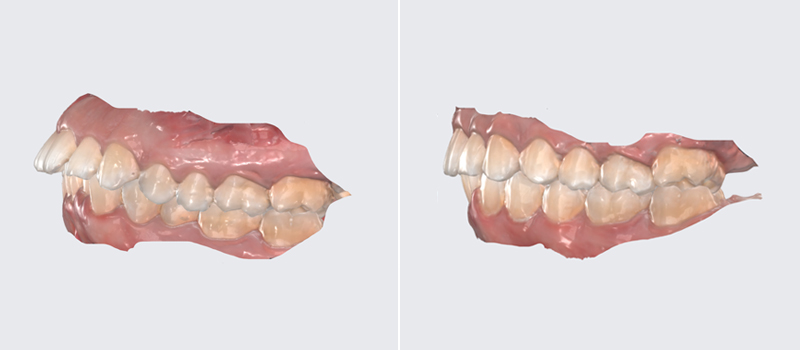Porcelain Crowns