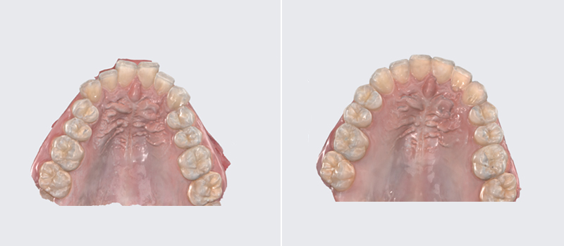 Porcelain Crowns