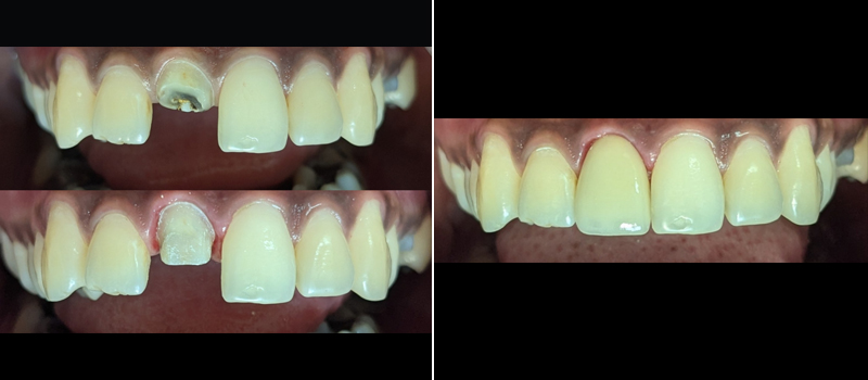 Dental Braces